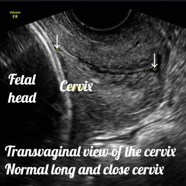 38 week baby ultrasound