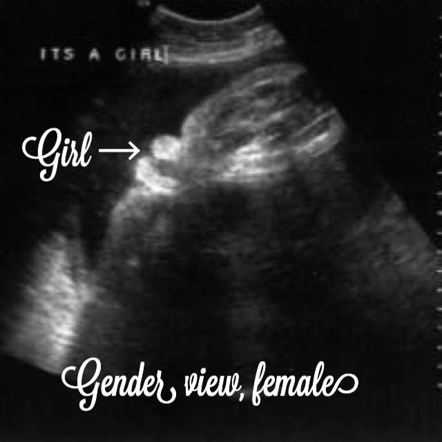 39 week pregnancy and ultrsaound, girl gender