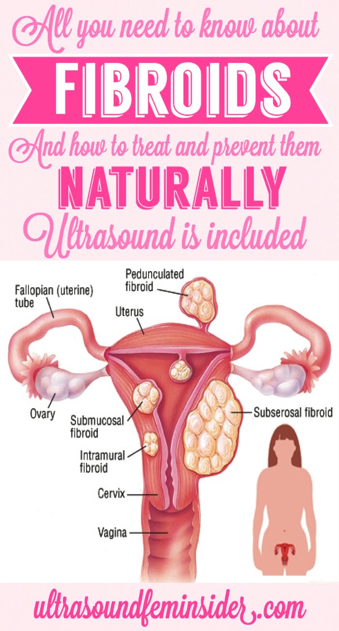 uterine fibroids