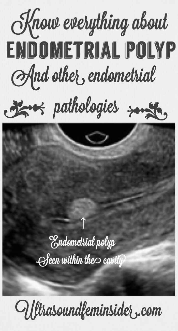Abnormalities on the Uterine cavity are crucial on the process of getting pregnant because is a possible cause of  Miscarriages and/or Infertility. This time I am covering Abnormalities of the Endometrium. #endometrialpolyps #endometrialultrasound