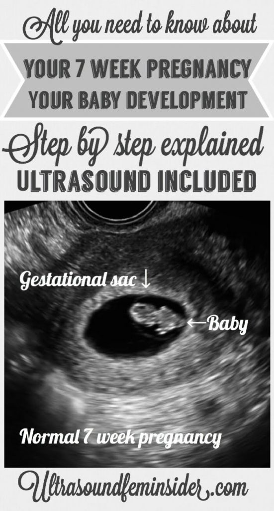 Normal 7 week baby ultrasound. - Ultrasoundfeminsider