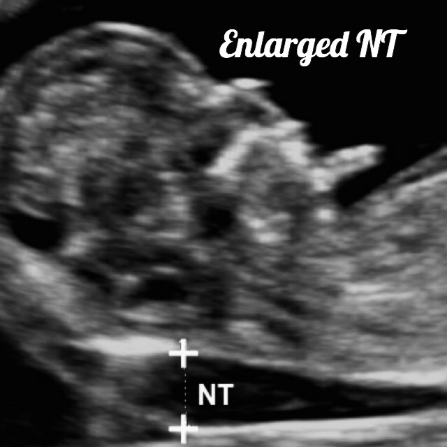 11 week ultrasound