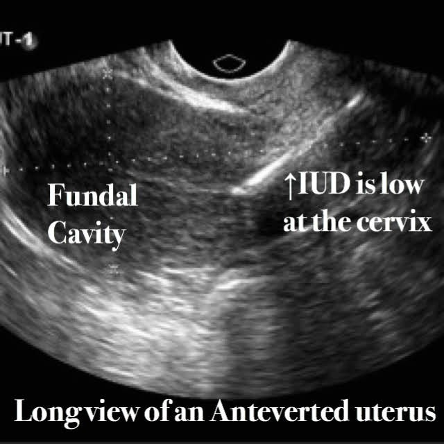 Normal IUD location