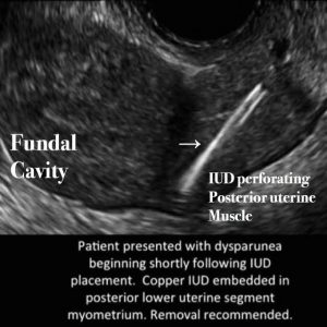 All about IUD or Intrauterine device. - Ultrasoundfeminsider