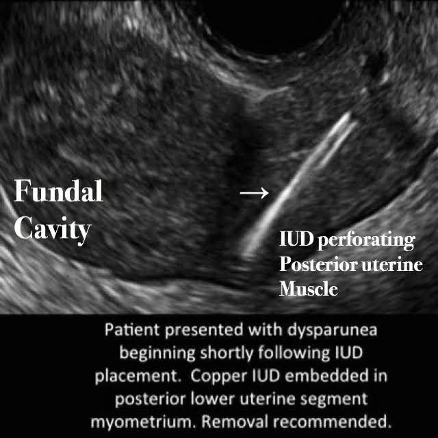 Abnormal IUD location