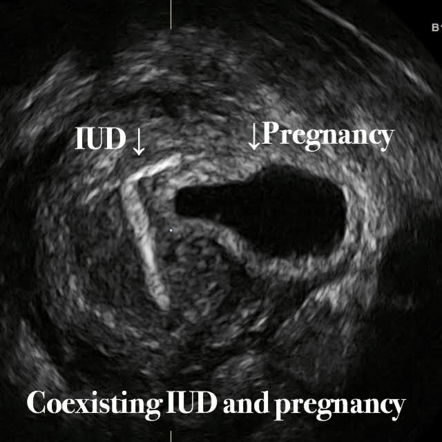 IUD and pregnancy