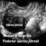 ultrasound image of a fibroid