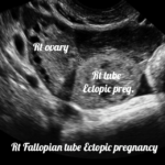 ectopic pregnancy ultrasound