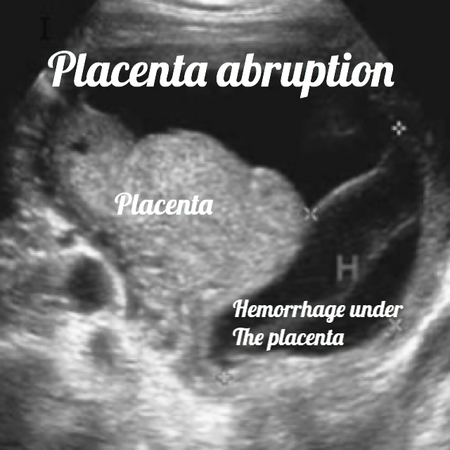 placental abruption ultrasound