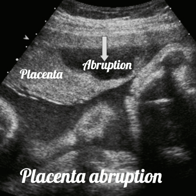 placental abruption ultrasound