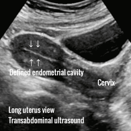 Endometrial ablation, all you need to know. - Ultrasoundfeminsider