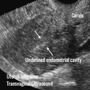 Endometrial ablation, all you need to know. - Ultrasoundfeminsider