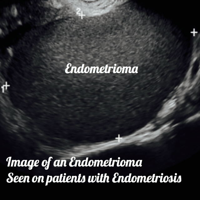 ultrasound images of pathologies that can cause irregular periods