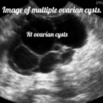 ultrasound image of an ovarian cyst