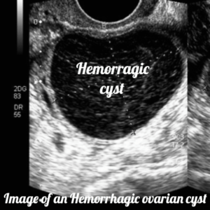 What are the Advantages and Disadvantages of Amniocentesis ...