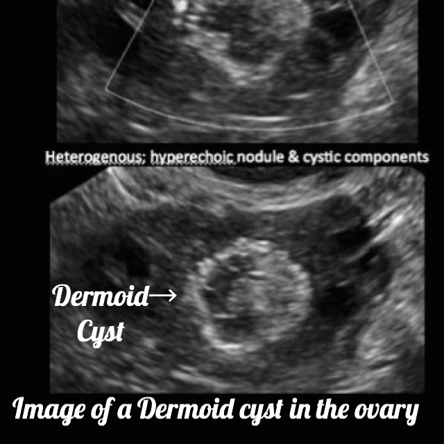 ultrasound image of an ovarian cyst dermoid