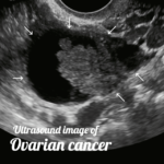 ultrasound image of an ovarian cancer
