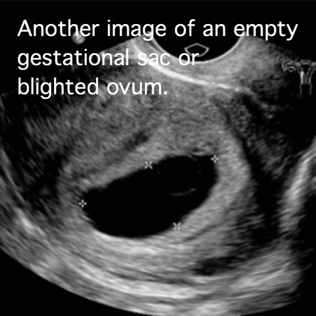 ultrasound of a blighted ovum