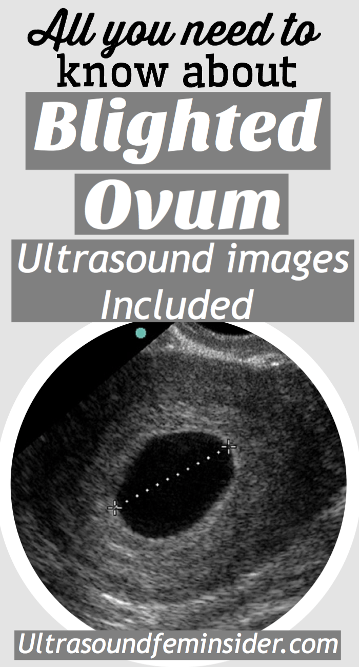Blighted ovum