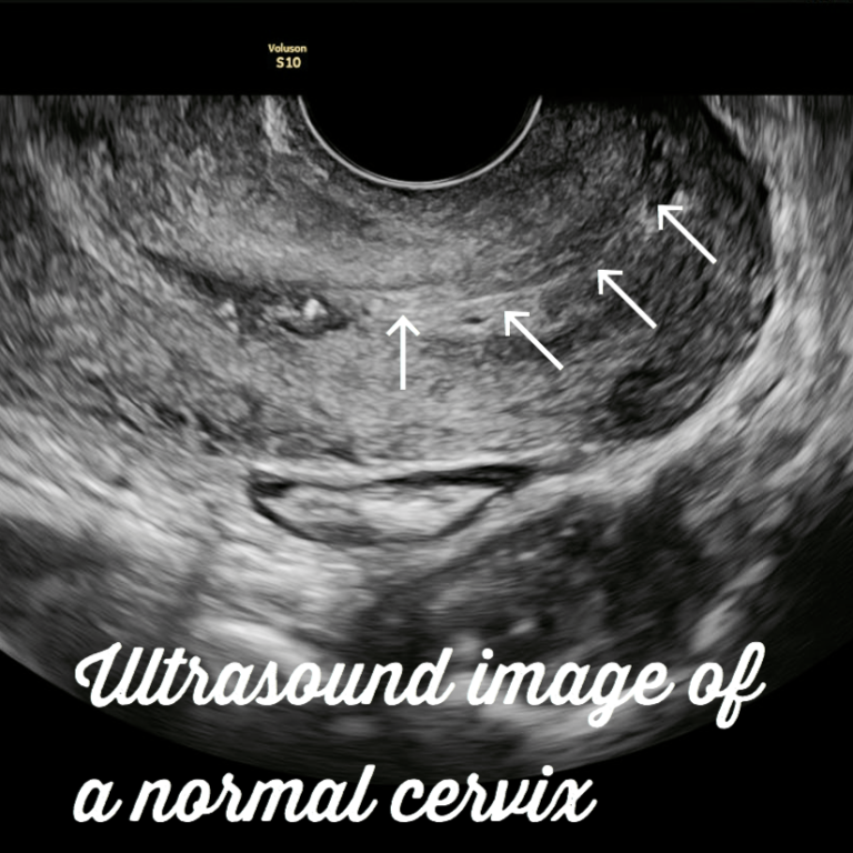 Cervical cancer. All you need to know. - Ultrasoundfeminsider