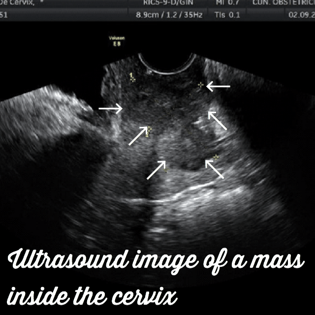 ultrasound image of Cervical cancer