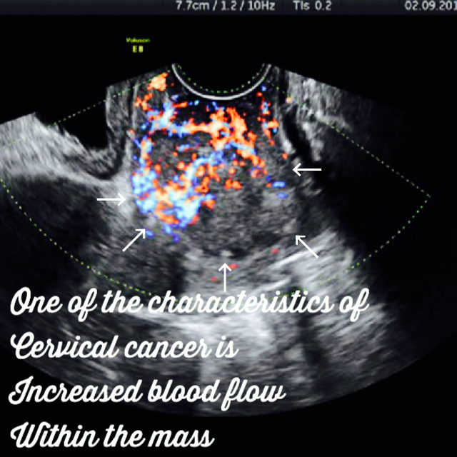 ultrasound image of cervical cancer