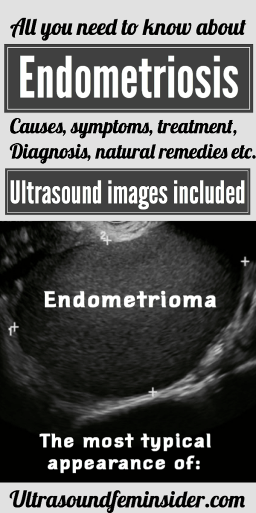 Endometriosis. Symptoms, diagnosis and treatment. - Ultrasoundfeminsider