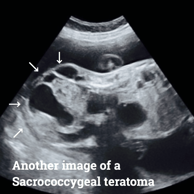 Teratoma Causes Symptoms Diagnosis And Treatment Ultrasoundfeminsider Teratoma Causes Symptoms Diagnosis And Treatment Ultrasoundfeminsider