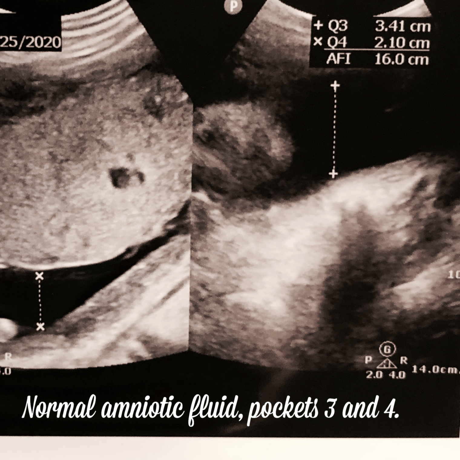 amniotic fluid.