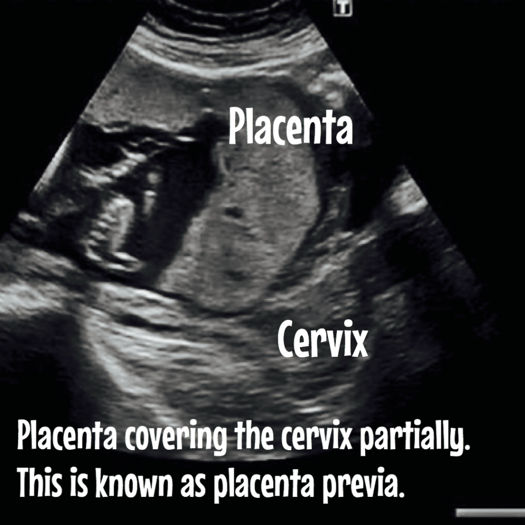 everything-about-the-placenta-ultrasound-included-ultrasoundfeminsider