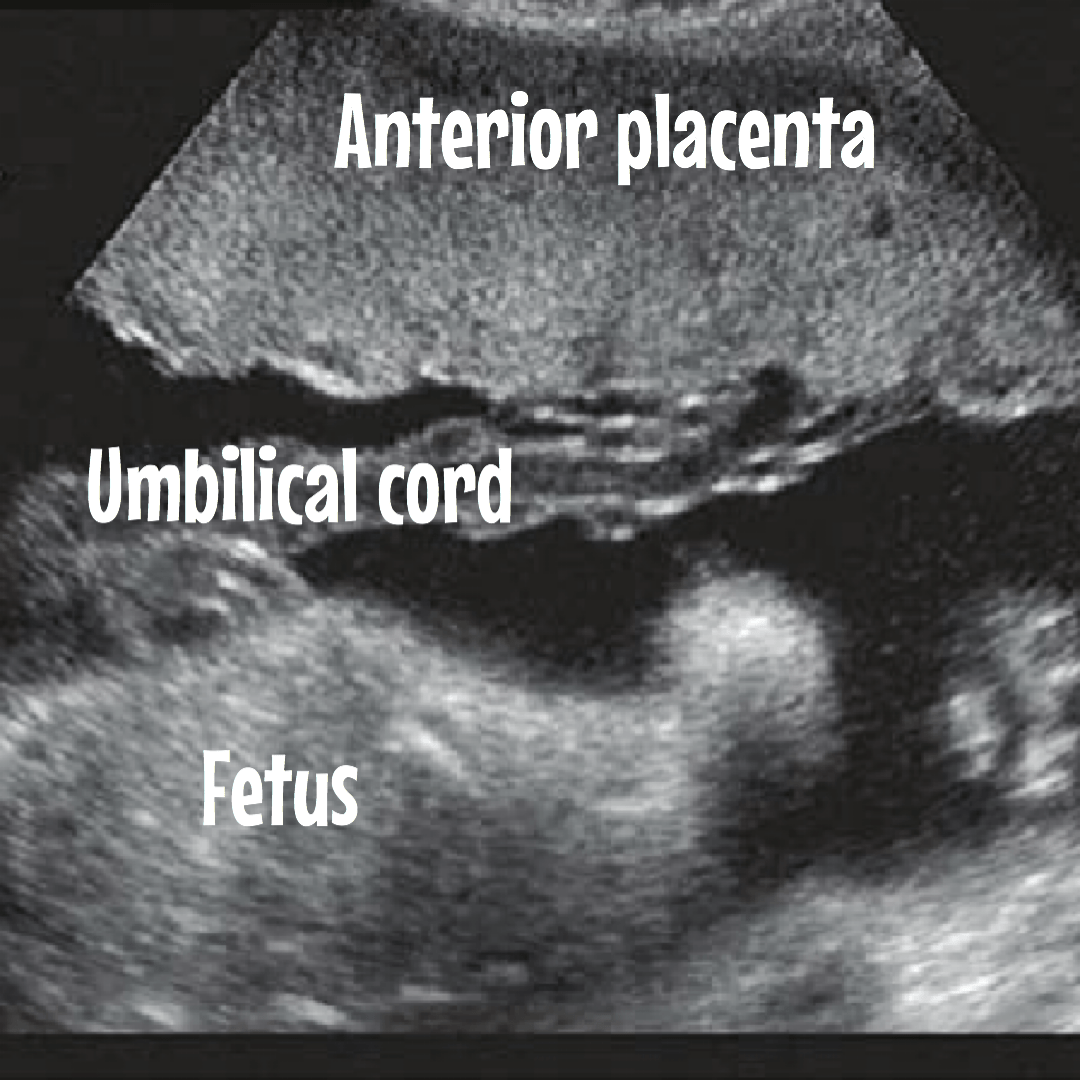 Everything you need to know about the placenta. Ultrasound images included.