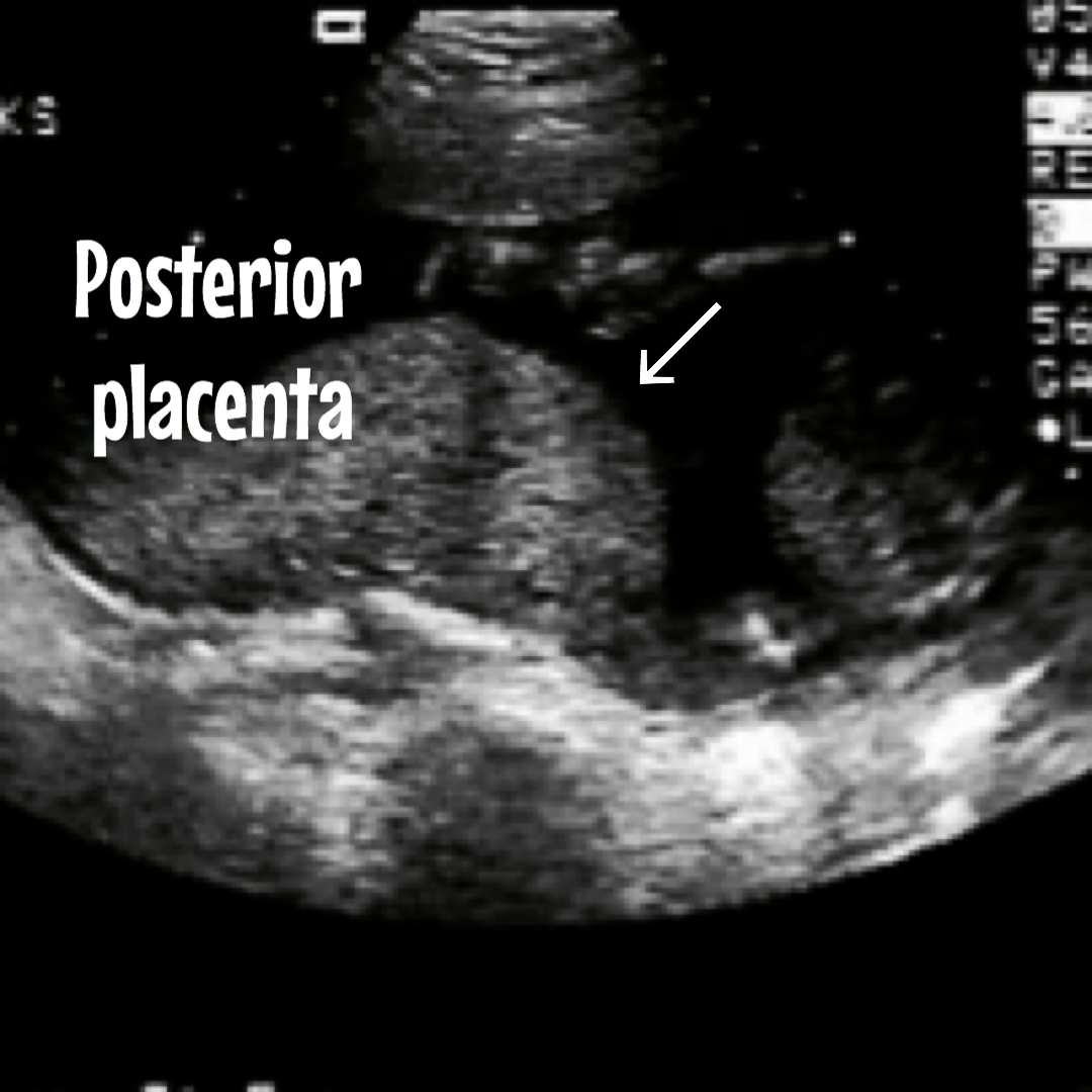 Everything you need to know about the placenta. Ultrasound images included.