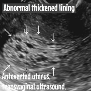 Endometrial hyperplasia. Causes, risks, ultrasound and treatment ...