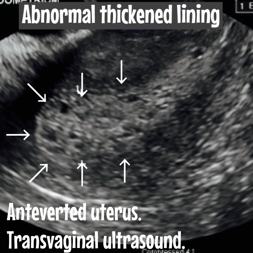 Beautiful view of Endometrial Hyperplasia Treatment Options
