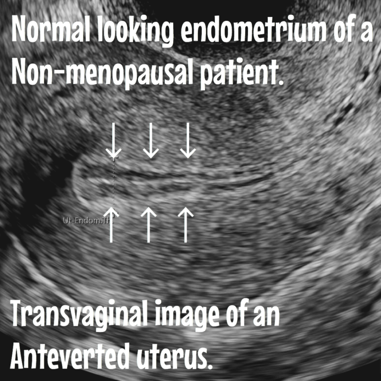 Endometrial hyperplasia. Causes, risks, ultrasound and treatment ...