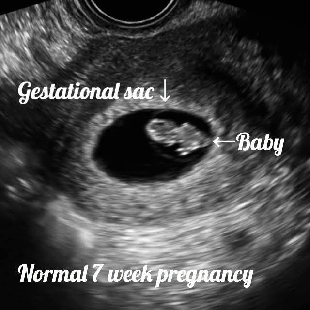 7 weeks ultrasound baby