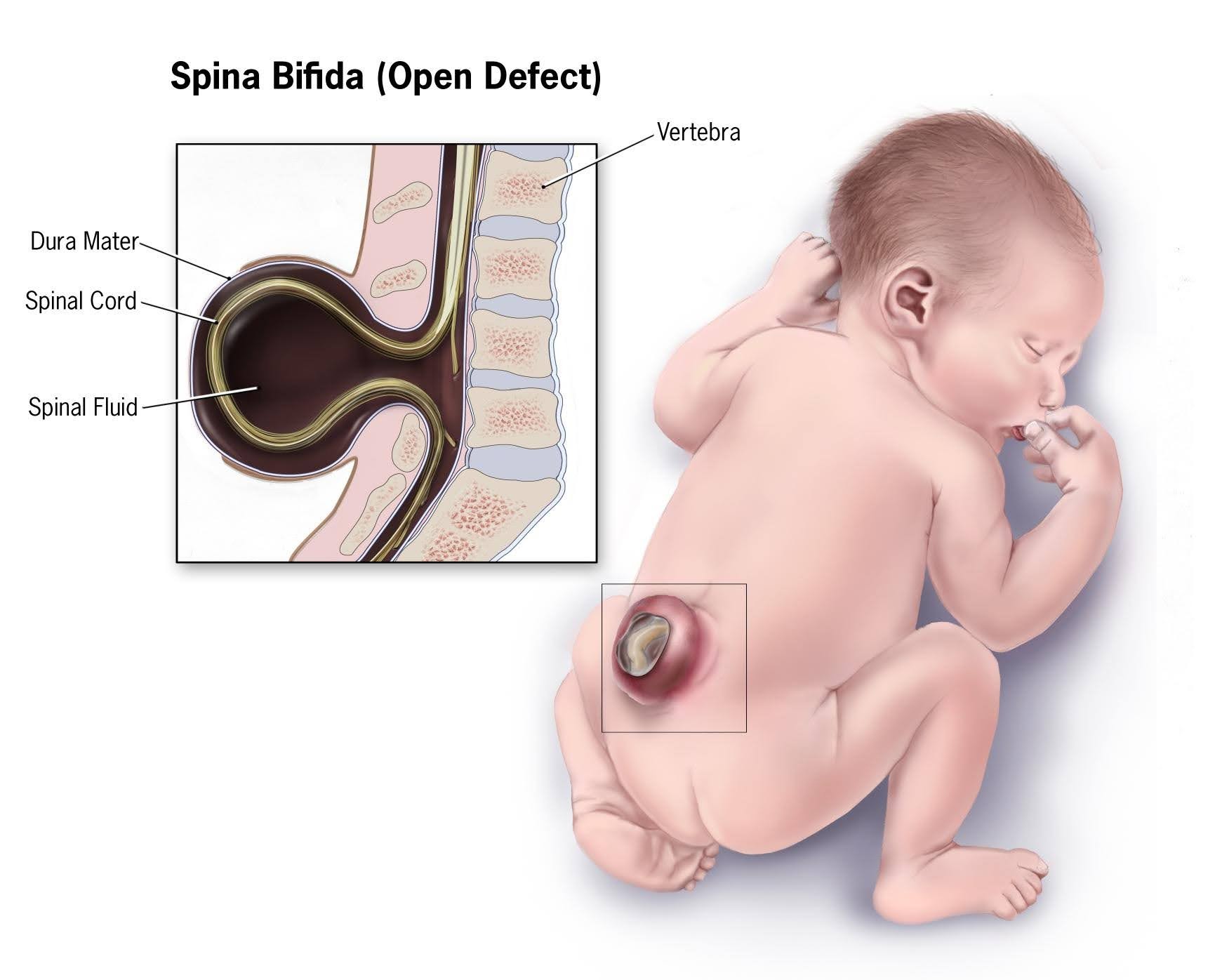 In this article I am going to give you the most important information related to spina bifida, and you will also find ultrasound photos related to the diagnosis of spina bifida.