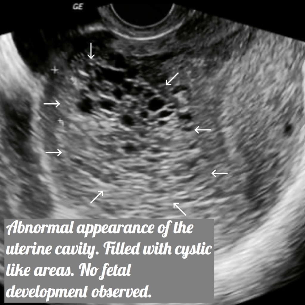 Molar Pregnancy Information Ultrasound Included Ultrasoundfeminsider 