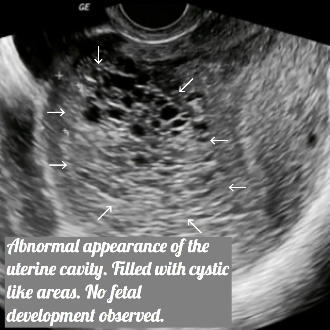 ultrasound image of molar pregnancy