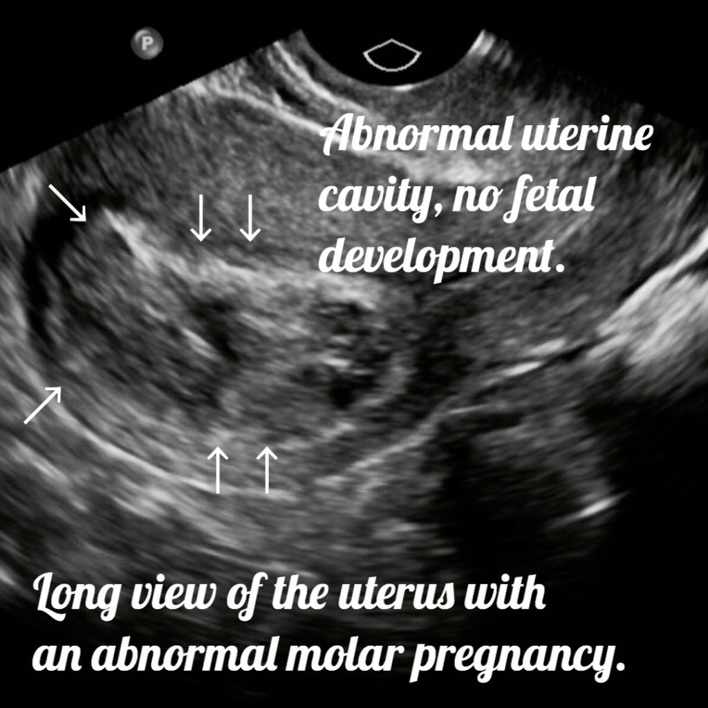 clinical presentation of molar pregnancy