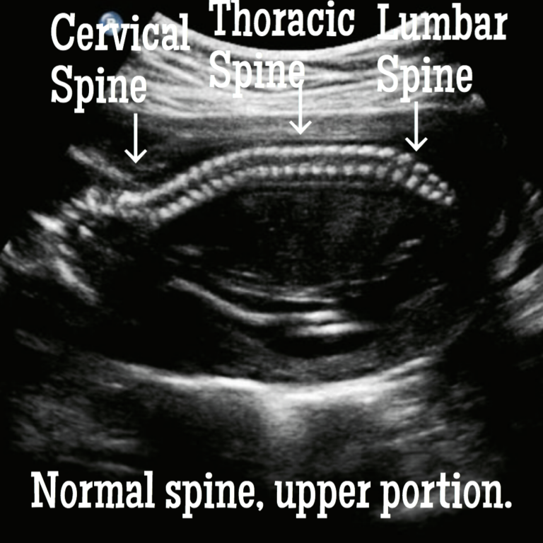 Information about Spina Bifida ultrasound.