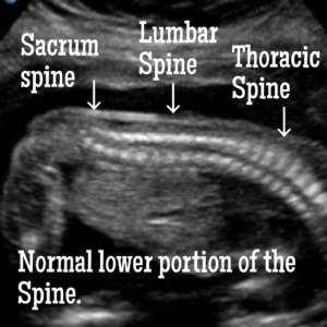 Information about Spina Bifida ultrasound.