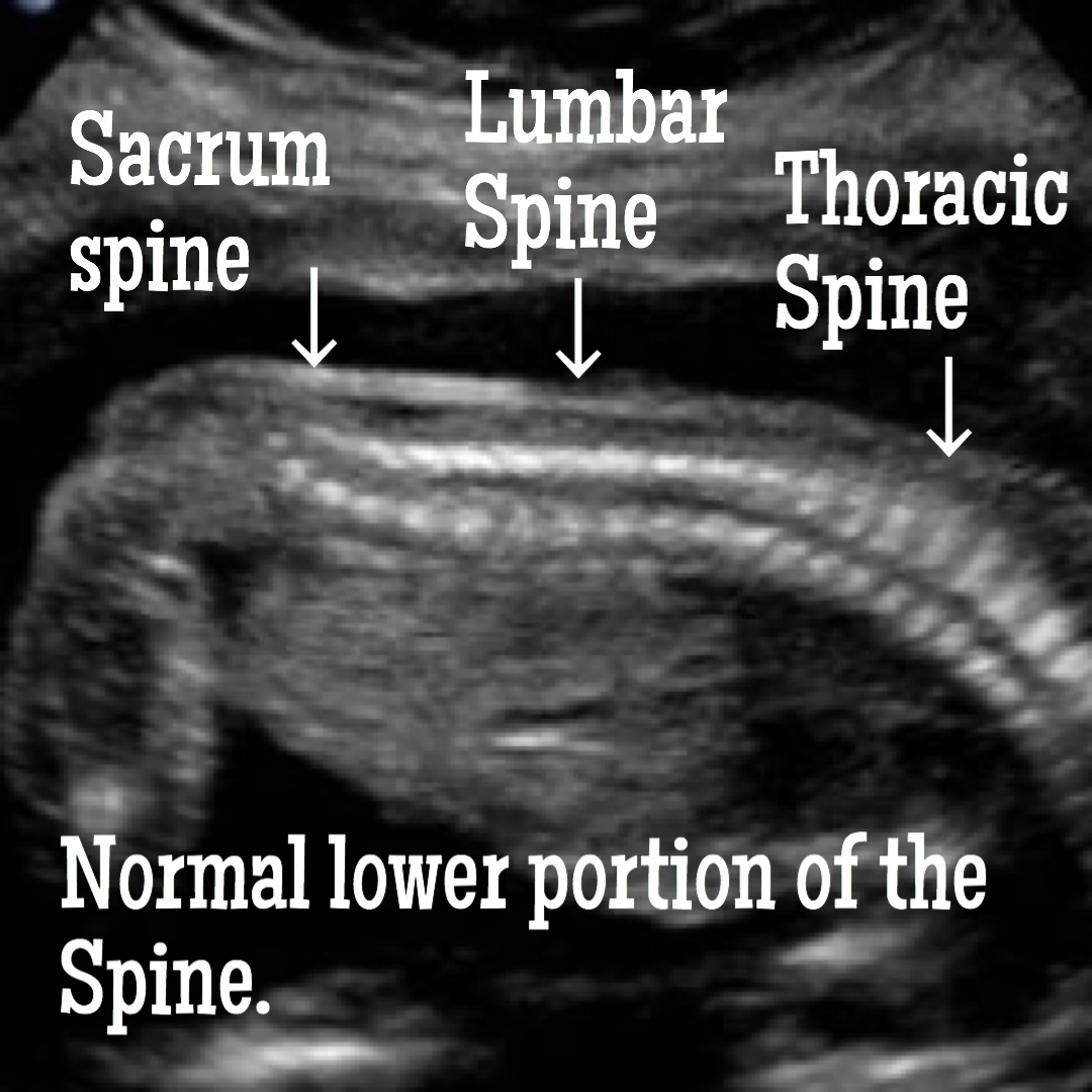 spina bifida ultrasound