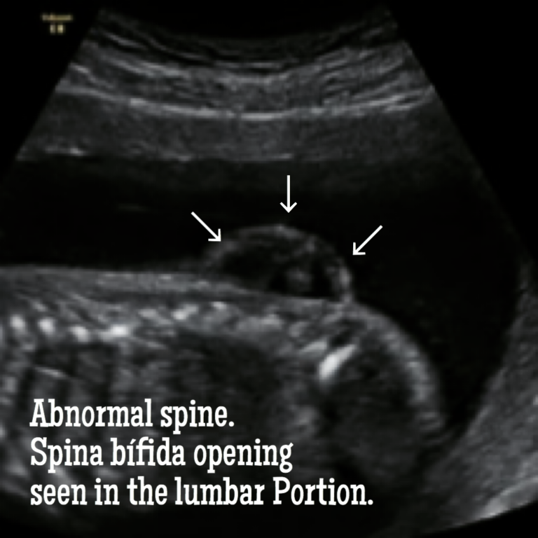 Information about Spina Bifida ultrasound.