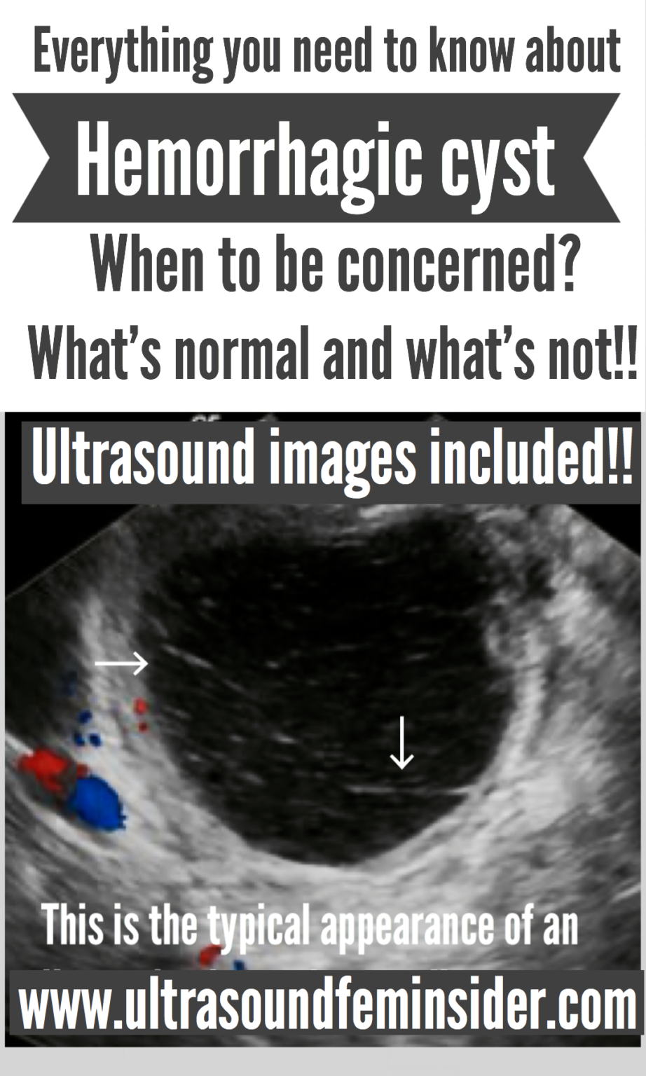 Hemorrhagic cyst. Cause, symptoms, complications, ultrasound ...