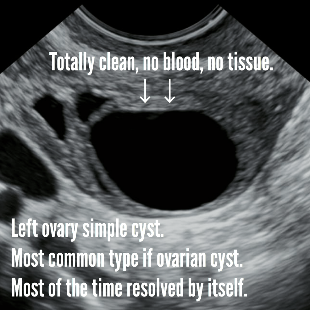 Hemorrhagic cyst. Cause, symptoms, complications, ultrasound ...