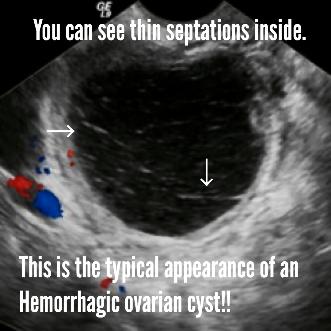 hemorrhagic ovarian cyst