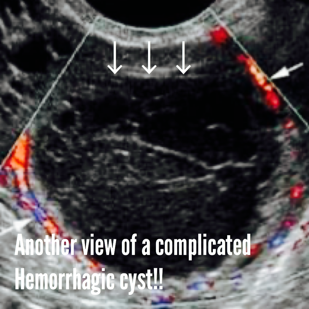 In this article I am going to give you all the information you should know about hemorrhagic cysts in the ovaries, you will find ultrasound images as well