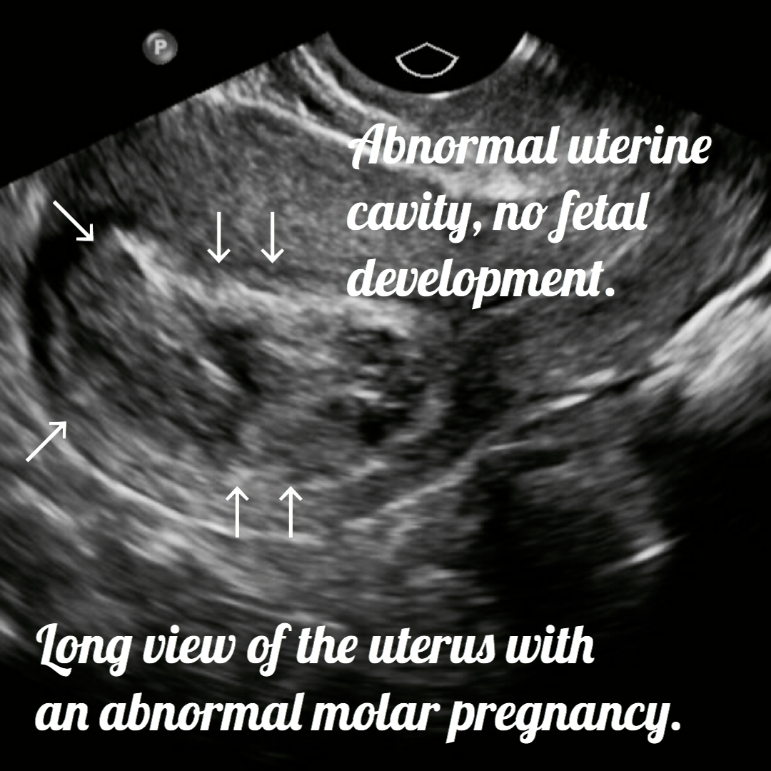 ultrasound image of molar pregnancy