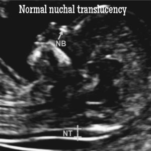 Prenatal Testing for Genetic Disorder. - Ultrasoundfeminsider